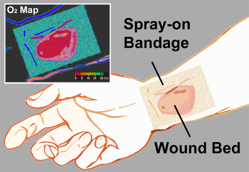 "Smart" Spray On Bandage Reports Healing Progress By Lighting Up